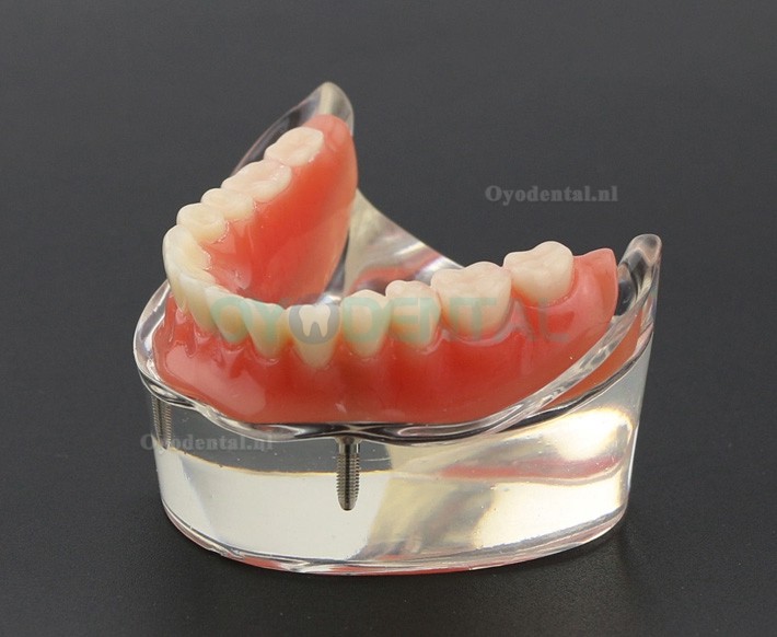 Tandentandenmodel Overdenture Inferieur met 2 implantaten Studiedemo Model 6002 01